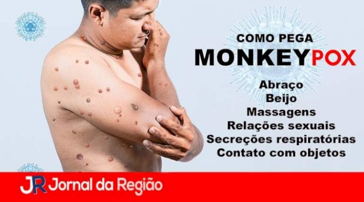 Confirmados primeiros casos de Monkeypox no interior Baiano
