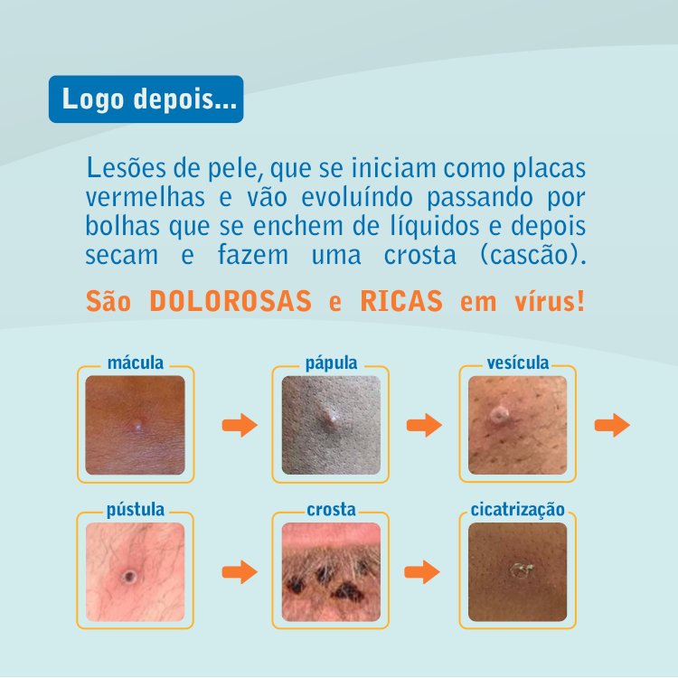 Saiba com riqueza de detalhes sobre a Varíola dos macacos.
